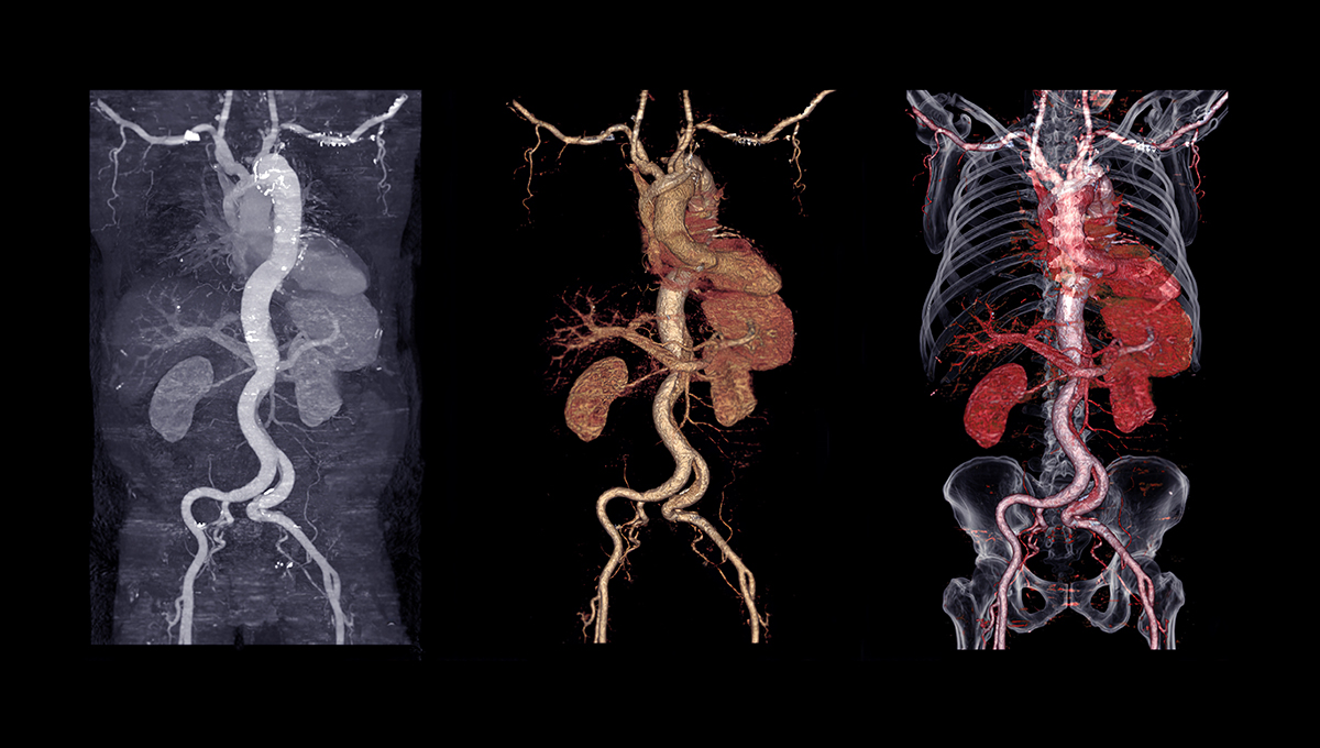 Aortic Disease Deaths Tied to Modifiable Risk Factors, Japanese